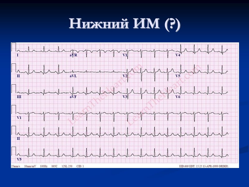 Нижний ИМ (?)